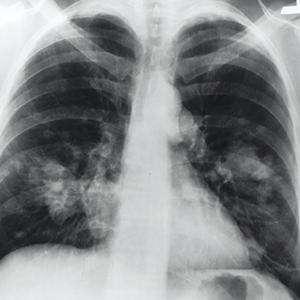 Lungdisease Lungdisease
